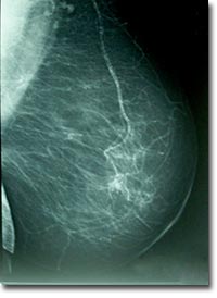 ciencia-mamografia-diagnostico